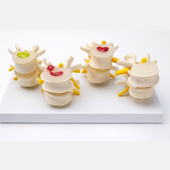 Anatomical Model -4-stage Lumber Vertebrae Disorder 四阶段病态腰椎比较模型